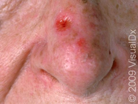 This image displays squamous cell carcinoma on the nose, a frequent location due to chronic sun exposure.