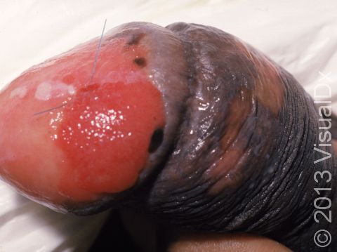 This image displays squamous cell carcinoma on the penis.