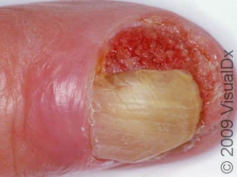 Squamous cell carcinoma can involve the fingertip and begin under the fingernail, as seen in this image.