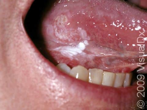 Large, white, slightly elevated lesions and an erosion of the tongue are signs of an oral squamous cell carcinoma.