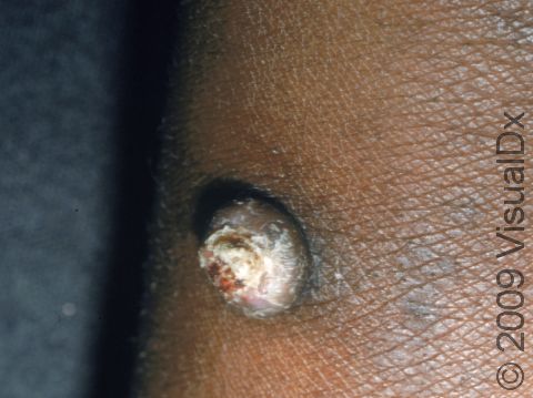 This image displays an elevated skin lesion typical of squamous cell carcinoma.