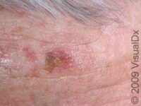 Squamous Cell Carcinoma (SCC) – Adult