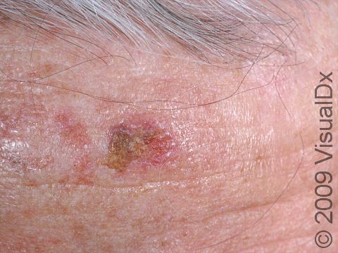 Squamous cell carcinoma typically develops in sun-damaged skin in fair-skinned patients.