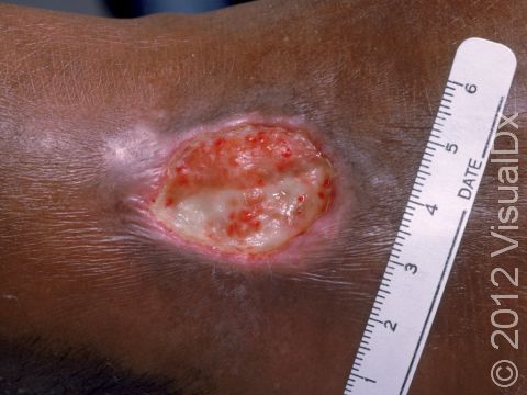 This image displays bright red blood vessels forming under an ulcer typical of a stasis ulcer that is starting to heal.