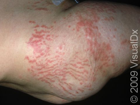 This image displays striae (stretch marks), which are common in pregnant women.