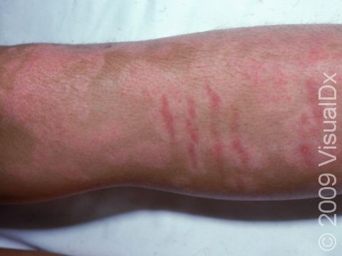 This image displays striae (stretch marks) that were a side effect of treatment for psoriasis.
