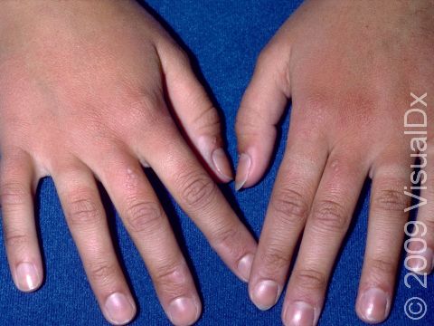 This image displays redness and small blisters on the tops of hands and fingers typical of sunburn.