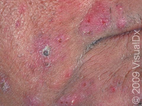 Fungal infection of the hair follicles, leading to pus-filled lesions and red, crusted bumps of the beard region are typical of tinea barbae.