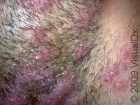 Ringworm, Beard (Tinea Barbae) – Adult