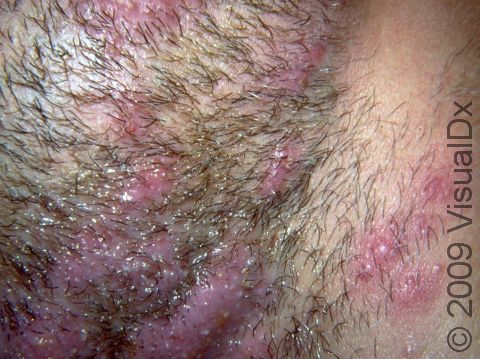 Multiple, inflammatory elevations of the skin around the hair follicle are typical of fungal infections in the beard area.