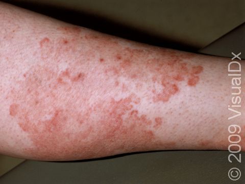 Multiple scaly, slightly elevated lesions can merge to form broad reddish-brown areas of skin.