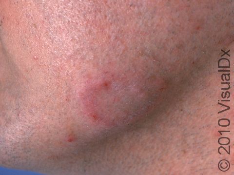 This image displays an early area of tinea on the jaw with a C-shaped, swollen red area that is slightly scaly.