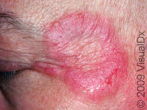 Fungal infections on the face are known as tinea faciale, as displayed in this image.