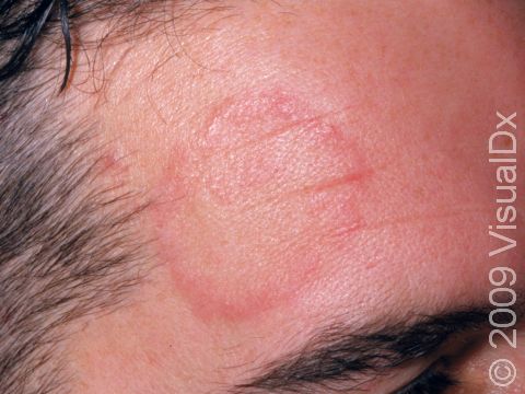 Tinea often has a red, round edge, as displayed in this image.
