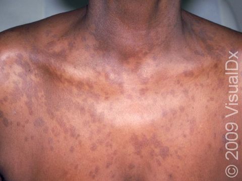 Tinea versicolor can present with dark flat areas, as seen in this patient, or areas of lighter skin lesions.