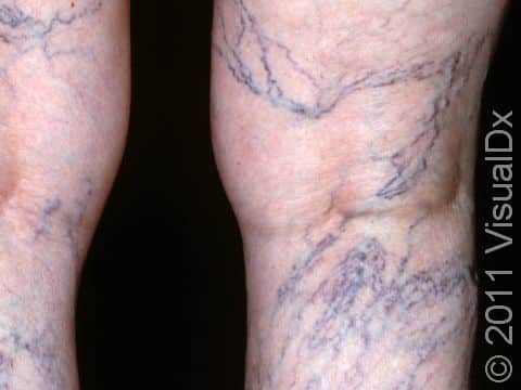 Varicosities (numerous superficial veins) are common, particularly in women.