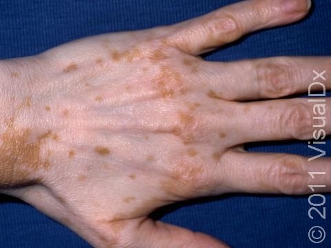 This image displays an almost total pigment loss in a patient with vitiligo.