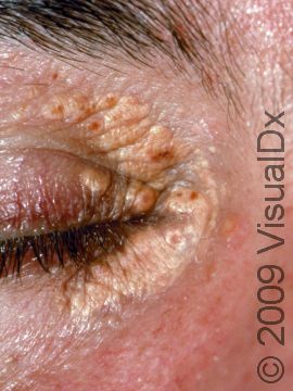 In xanthelasma, there are yellowish-brown elevated lesions on the skin of the eyelids.