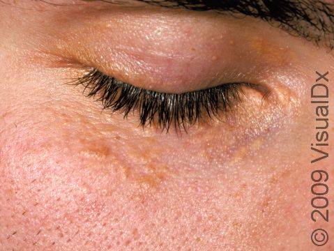 This image displays yellow-white elevations of the skin in a person with early xanthelasma palpebrarum.