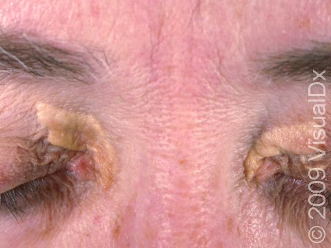 Xanthelasma is often, but not always, symmetric (appearing on both sides).