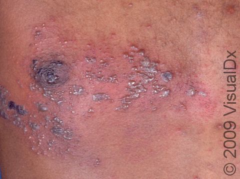 This image displays blisters that are grouped in a band from the chest to the back but does not cross the middle of the body, which is typical of zoster (shingles).
