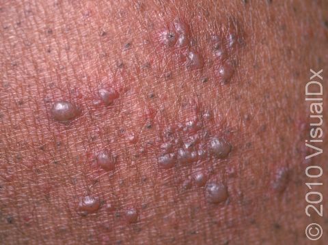 Shingles typically has numerous grouped, small and/or large blisters, as displayed in this image.