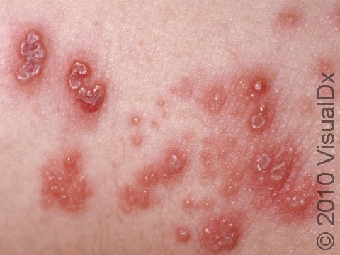 The typical early onset of zoster (shingles) includes blisters in groups. The blisters often have a central depression.