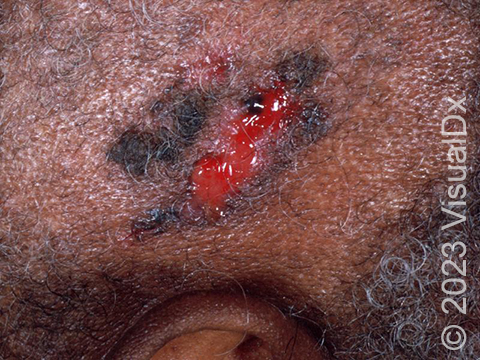 BCC of the face showing some hyperpigmentation and eroded skin.