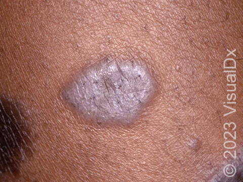 Close-up image of lichen planus, which is often characterized by raised red- to purple-colored lesions that itch.
