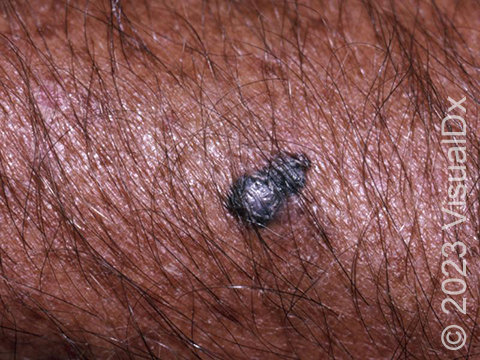 Melanoma often appears on sun-damaged skin as an irregular dark skin lesion that changes with time.