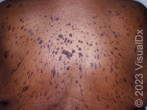 Pigmented seborrheic keratosis of the skin with its characteristic warty-like texture.