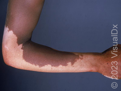 Large white vitiligo patch of the elbow and extremity.