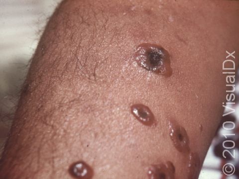 In cutaneous anthrax, skin lesions quickly turn into blisters (vesicles) then form black scabs (eschars). These anthrax lesions show the transition from blisters to eschars.