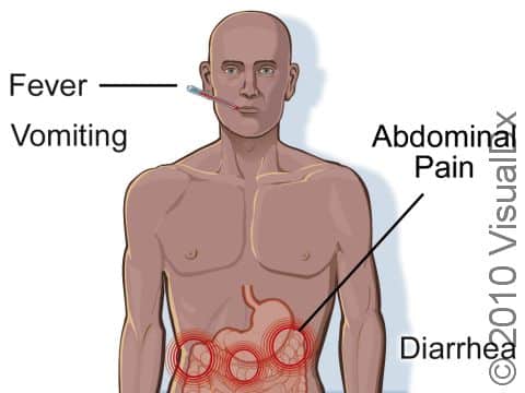 Gastrointestinal anthrax results in severe abdominal pain, diarrhea, high fever, and vomiting. This type of anthrax is nearly always fatal.