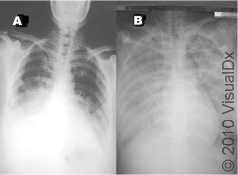 A patient with respiratory failure from avian influenza. Chest X-ray: A) patchy infiltration at bilateral lower lung fields. B) 24 hours later, shows rapidly progressive pneumonia in both lung fields, compatible with adult respiratory distress syndrome.