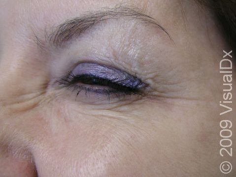 AFTER: Crow's feet 1 week after Botox injection, with the patient squinting.
