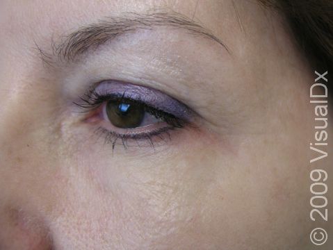 AFTER: Crow's feet 1 week after Botox injection, with the patient relaxing her face.