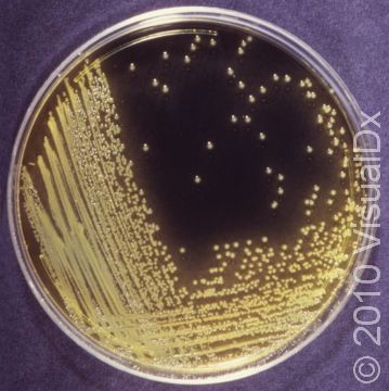 A bacterial culture plate tests positive for the bacterium Vibrio cholerae, the cause of cholera.