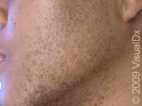 BEFORE: The cheek of a patient with ethnic skin before laser hair removal.