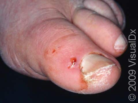 Bites like this one can occur as a result of not wearing protective footwear while walking through wooded or grassy areas.