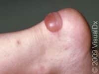 Blisters: Causes, Treatment, and Prevention