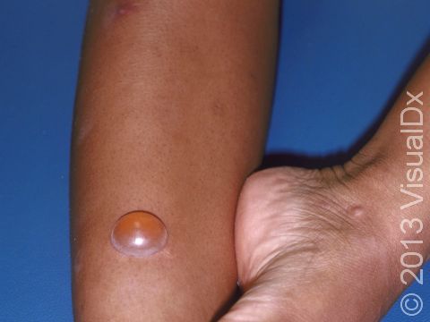 Some people react to insect bites with large, fluid-filled blisters.