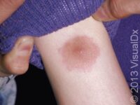 Bug Bites or Stings, First Aid – First Aid