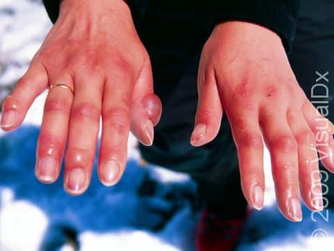 Severe frostbite can result in blisters in addition to hard, frozen skin, and it can be limb-threatening.