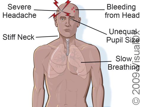Head trauma signs and symptoms can include severe headache, bleeding from the head, stiff neck, slow breathing, weakness or inability to use limbs, persistent vomiting, decreased alertness, and/or convulsions.