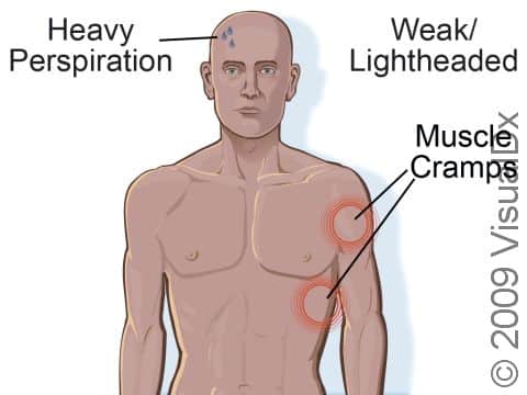Heat cramp signs and symptoms can include heavy perspiration, muscle cramps (often in the legs, arms, abdomen, and back), and weakness/lightheadedness.