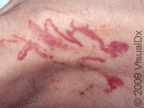 The rash caused by a jellyfish sting is often red and swollen, and it may even bleed.