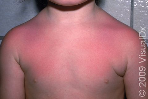Sunburns on the shoulders and upper chest are very common and range in color from pink to red.