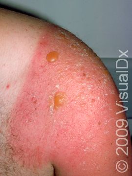 Severe sunburns such as this one often result in blistering.