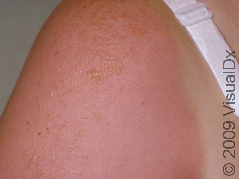 Skin can become blistered following a severe sunburn.